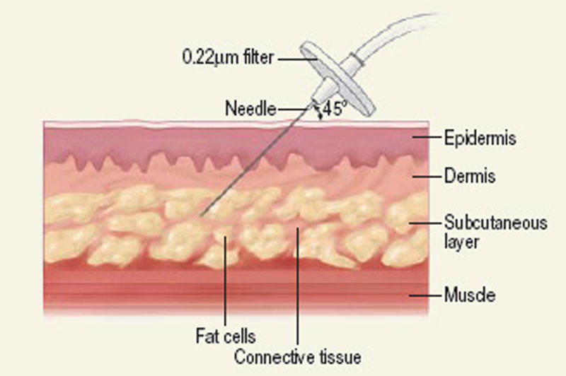 نحوه کار کربوکسی‌تراپی کربوپلاس
