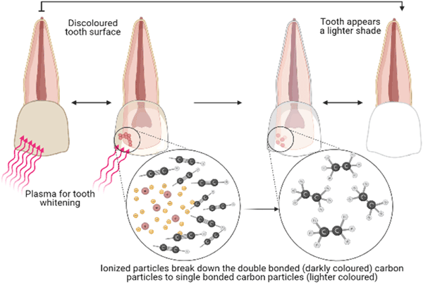 درمان لیزر دندانپزشکی برای سفید کردن دندان و جراحی لثه