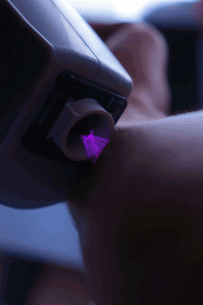 درمان چین و چروک با پلاسمای فرکشنال در رکسانامد