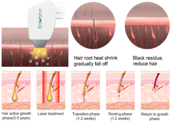 نحوه کار لیزر رکسانا آیس