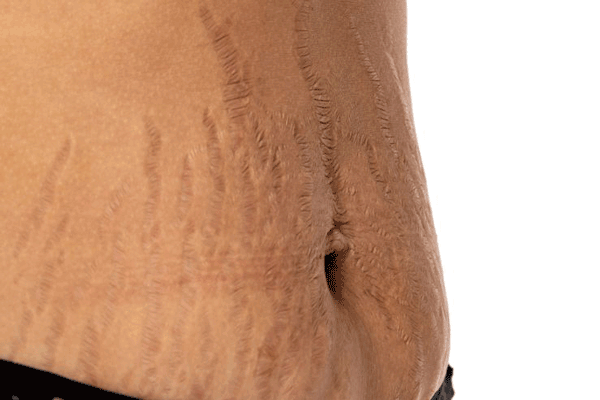 نمودار علل استریا شامل ترک‌های بارداری و کاهش کلاژن